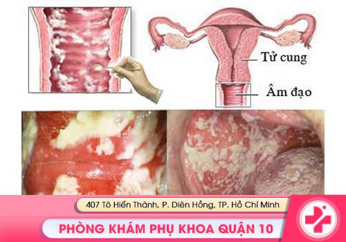 Viêm âm đạo, viêm cổ tử cung gây vô sinh ở nữ giới