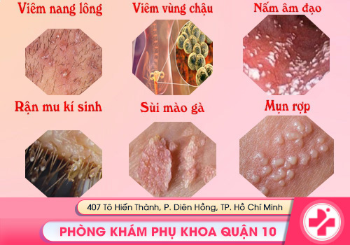 Một số bệnh lý gây ngứa vùng kín ở nữ giới